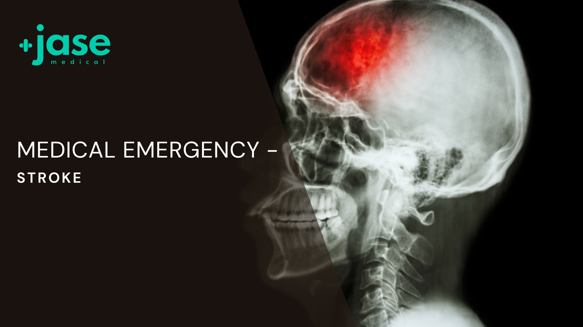 Medical Emergency – Stroke