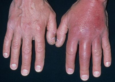 Cellulitis can be Life Threatening