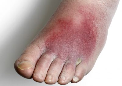 Cellulitis can be Life Threatening